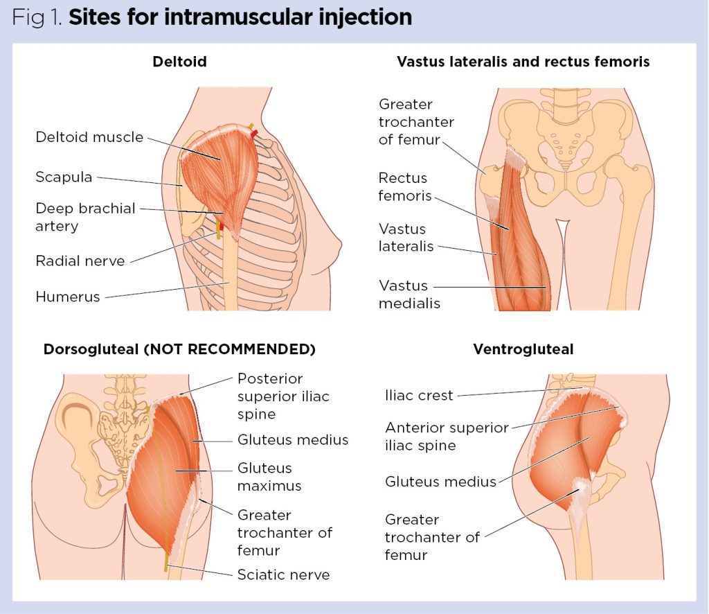 Injection Sites for Mic/b12 injections and lipolean injections